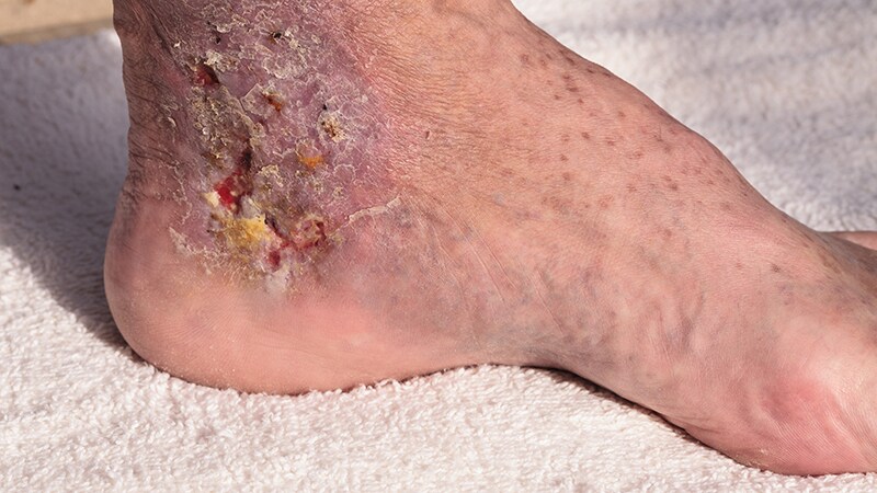 Cellulitis Care Costly From Misdiagnosis, Needless Hospitalizations