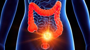 Targeted Combos Improve QoL as Well as Survival in CRC
