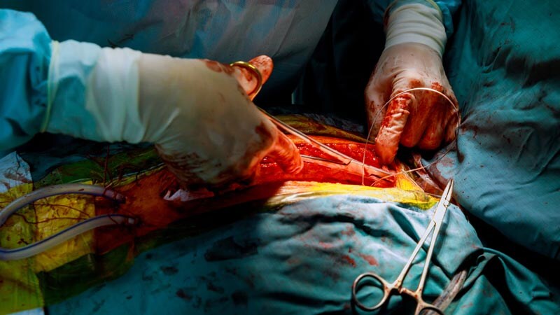 Procedure Reduces Postop AF After Cardiac Surgery: PALACS 