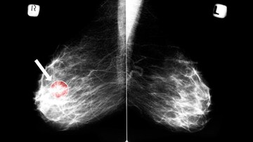 Sarcopenia Nearly Doubles Risk Women Will Quit Endocrine Therapy
