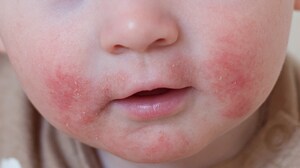 Survey Highlights Burden of AD for Many Infants and Preschoolers