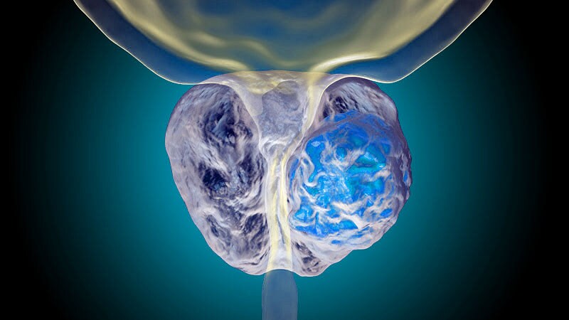 Enzalutamide Ups Mets-Free Survival, QoL in Prostate Cancer