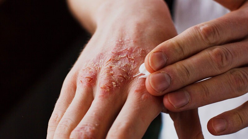 Improvements in Chronic Hand Eczema Seen With Oral Gusacitinib