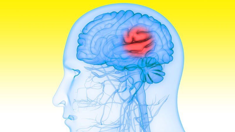 Disabling Stroke Reduced With Ticagrelor After Minor Stroke, TIA 