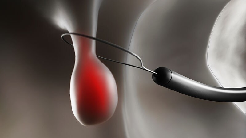 Cold Snare Polypectomy Underused Despite Recommendations