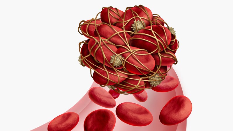 VTEs Tied to Immune Checkpoint Inhibitor Cancer Treatment