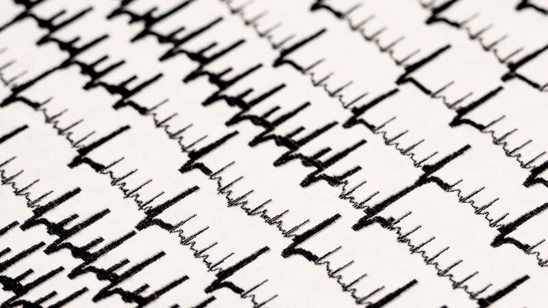 SGLT2 Inhibitor Use Tied to Fewer Atrial Arrhythmias