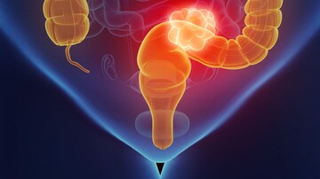 Surgery Is Falling Out of Favor in Rectal Cancer