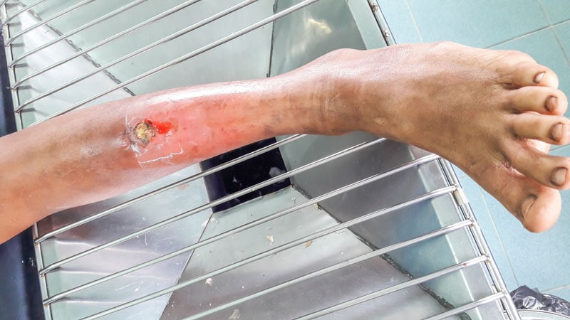 Expert Offers Clinical Pearls on Leg Ulcer Therapy