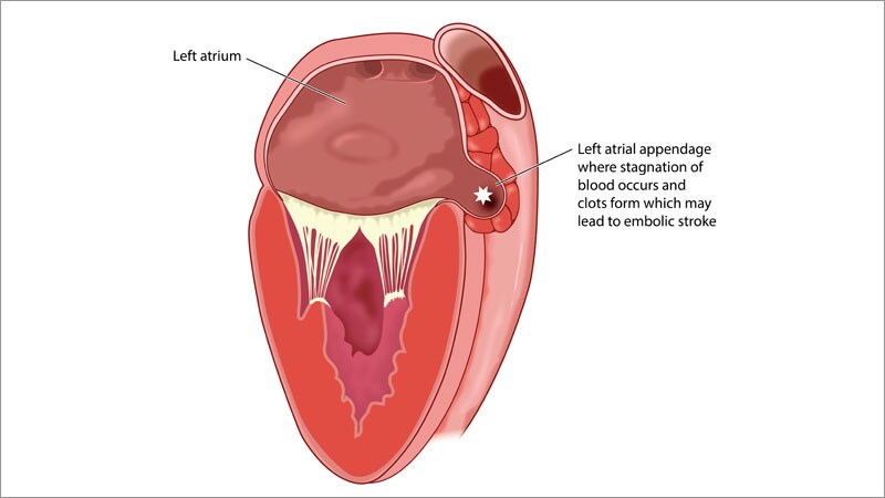 Different Strengths for LAA Closure Devices?