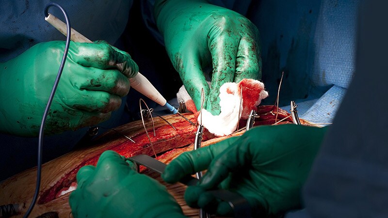 CABG Safe 3 Days After Stopping Ticagrelor: RAPID CABG  