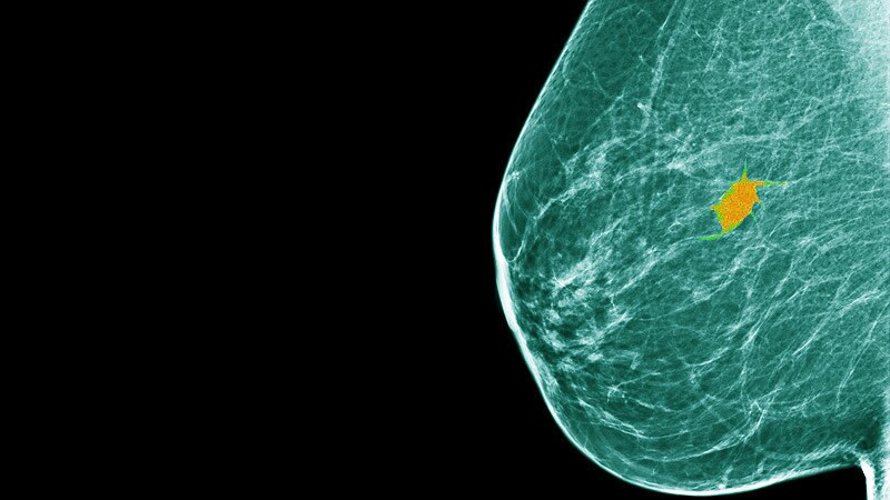 Omitting Surgery May Be Safe in Early BC After pCR