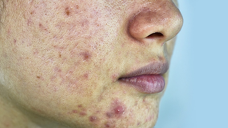 No Sequelae From Lab Abnormalities in Isotretinoin Study