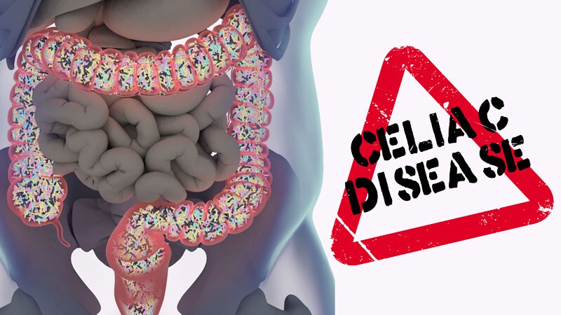 New Treatments Under Study for Celiac Disease