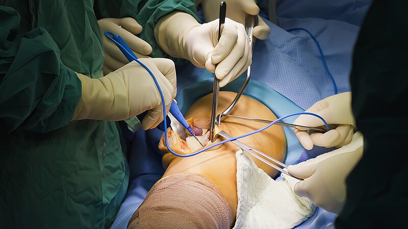 Knee Surgery Surge Not Linked to Premature Intervention