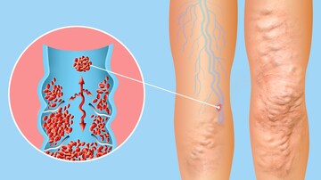 Consider Cancer as a Trigger for Deep Vein Thrombosis
