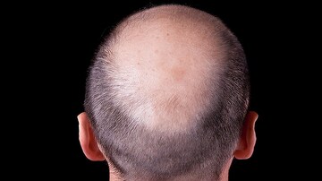 Lawsuit Brings Renewed Attention to Finasteride Adverse Events