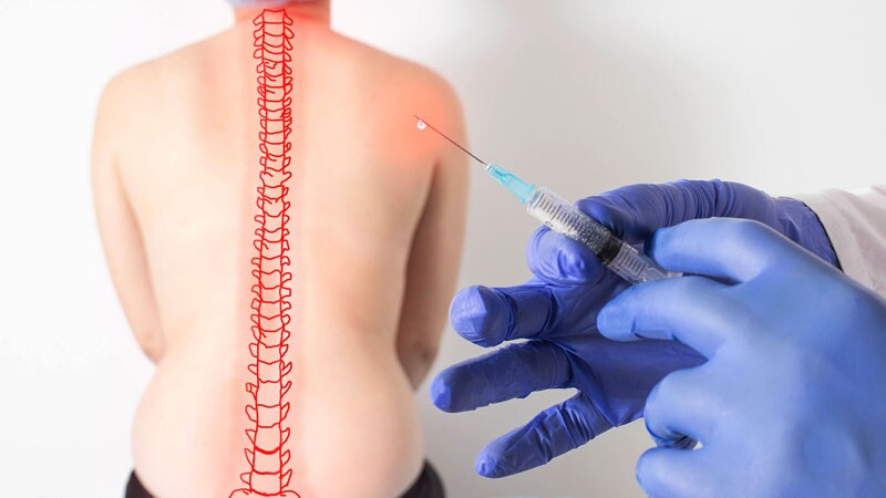 Lumbar Epidural Steroid Jab Lowers Bone Formation in Older Women