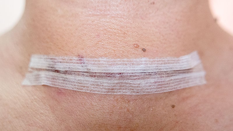 Hypoparathyroidism Rates Low After Thyroidectomy for Graves Disease