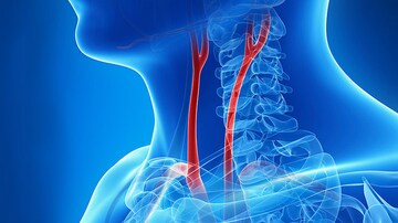High IL-6 Levels Linked to Carotid Plaque Severity, Progression