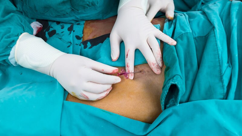 Transfemoral TMVR a Limited Success in Early Feasibility Study