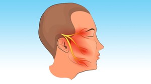 Trigeminal Neuralgia: Intraorbital Cuts Help Some Patients 