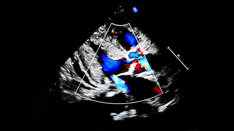 PASCAL for MV Repair Noninferior to MitraClip: Pivotal CLASP IID