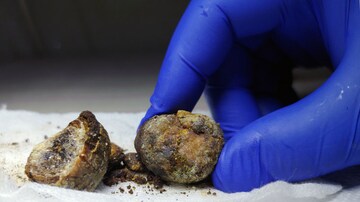 Gallstone Disease May Be a Harbinger of Pancreatic Cancer