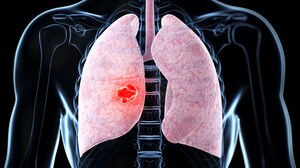 Preop Nivolumab Plus Chemo 'a Quantum Leap' in NSCLC Therapy