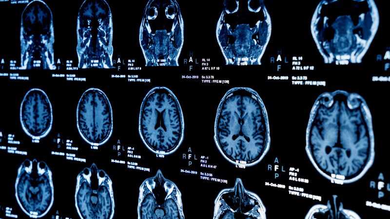 More Brain Aging in Older Patients With Childhood Epilepsy