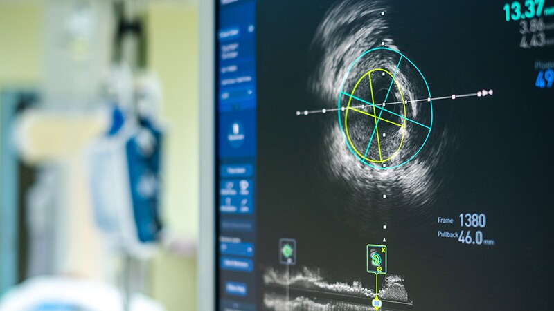 FFR Not Better, Just Different From IVUS for PCI