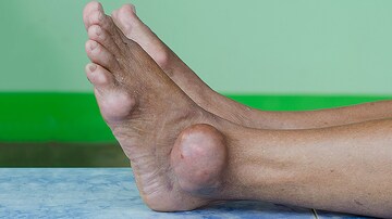 Allopurinol Found Safe in Patients With Concomitant Gout, CKD