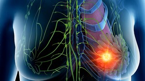 'No Discernible Benefit' Adding Nivolumab to ADC in Breast Cancer