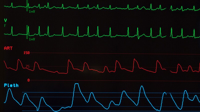 Fast Five Quiz: Atrial Fibrillation Treatment and Management