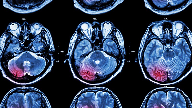 Thrombolysis Not Necessary in Mild Nondisabling Stroke: ARAMIS