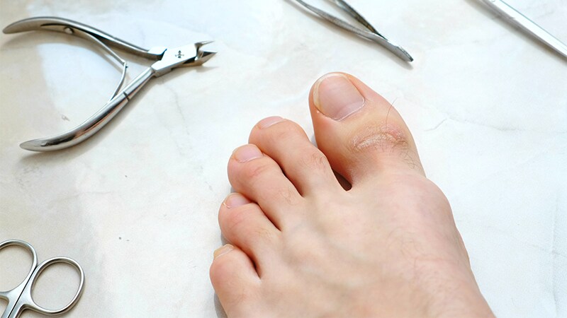 Clinical Clarity Grows About Toenail Disorder, Experts Report  