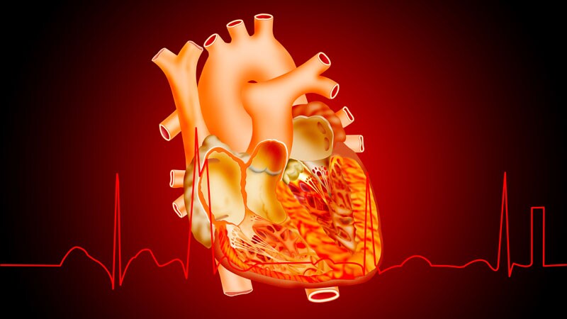 Anticoagulation Not Routinely Needed After TAVR: ADAPT-TAVR