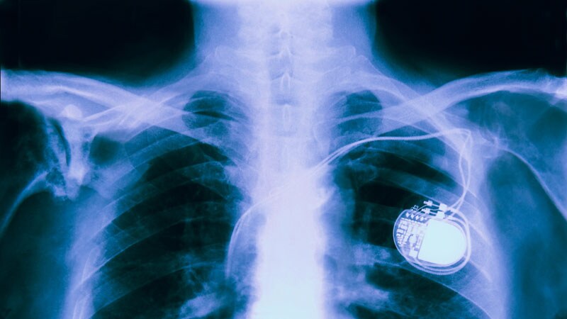 Extraction of Infected Implanted Cardiac Devices Rare