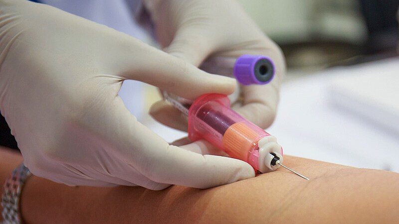 Novel Tau Blood Biomarker Shows Promise