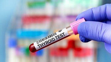 Biotin: Good for Hair and Nails, Bad for Thyroid Lab Tests 