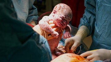Hypertension + Advanced Age Linked to More Cesarean Deliveries