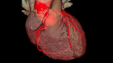Mixed Interim Results for Combination Imaging in CABG Patients