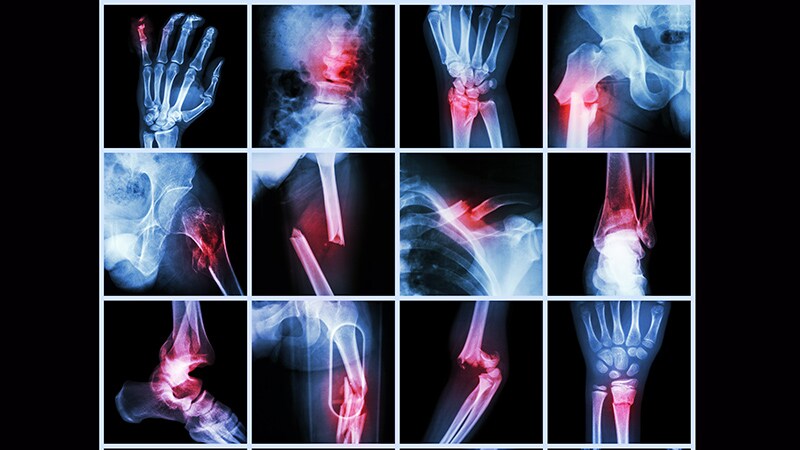 Fractures Beget Fractures at Any Age