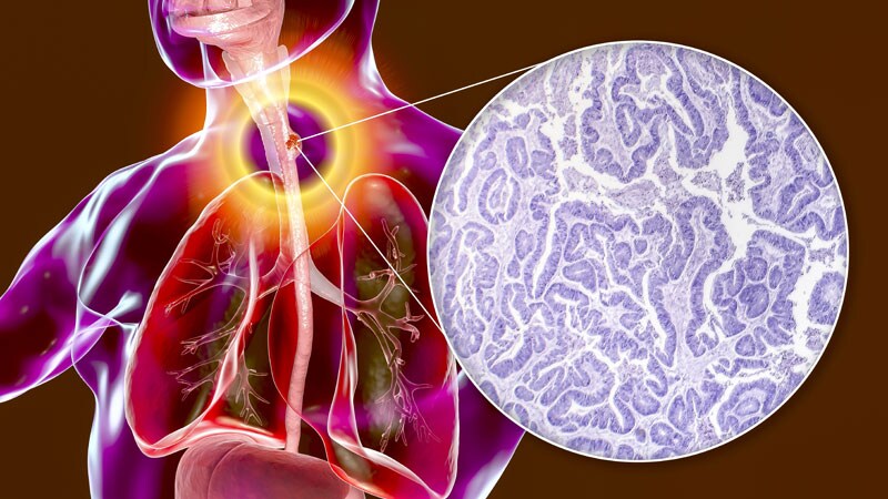 Can Some Patients With Esophageal Cancer Avoid Surgery?