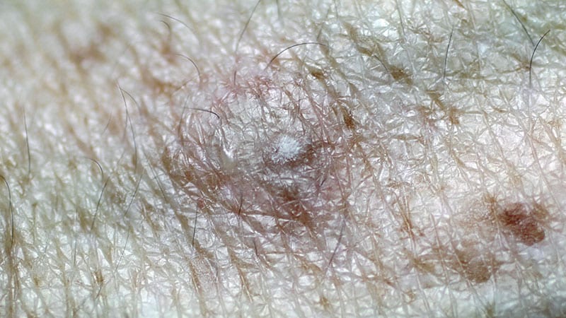 Polypodium Leucotomos Found to Reverse AK Skin Damage