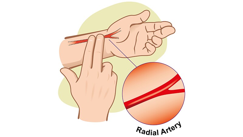A Week of Anticoagulation Halves Post-PCI Radial Occlusion Rate