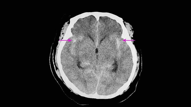 Combo Thrombolytic Approach Fails to Reduce ICH in Stroke  