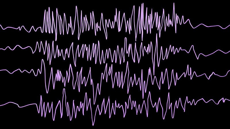 Seizures in Dementia Hasten Decline and Death