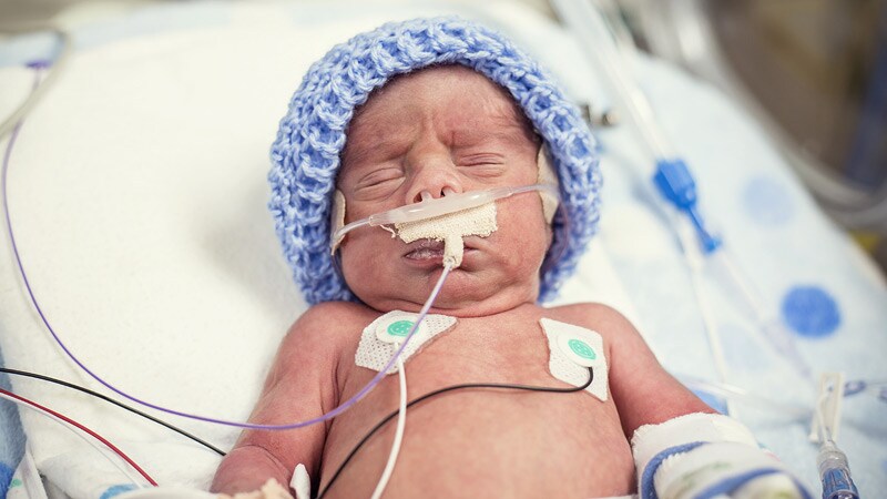 Formula-Fed Extreme Preemies Need More Iron: Study