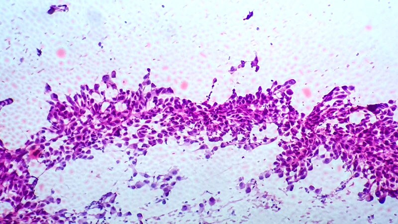 Perioperative Nivolumab Improves EFS in Resectable NSCLC